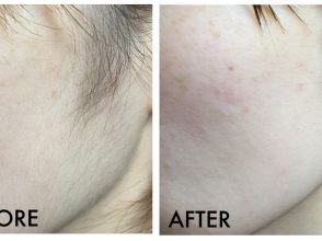 うぶ毛剃り,before,after