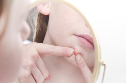 ■皮膚科医が解決！繰り返すニキビはどうしたらいい？