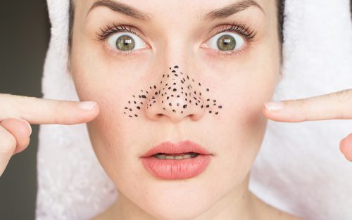 毛穴パックはOK?押し出していい?角栓の正しい除去方法を医師に聞いてみた