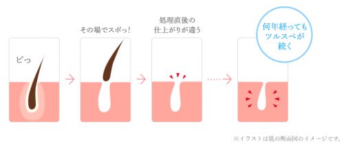 美容電気脱毛